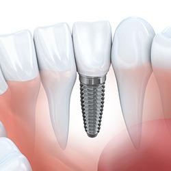 single dental implant cost