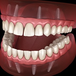 dental implants and gum disease
