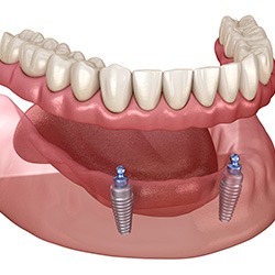 Finding Dental Implants for Seniors and Transforming Your Smile